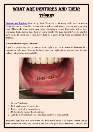 what are dentures and their what are dentures