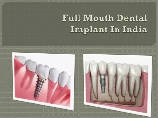 Full Mouth Dental Implant In India