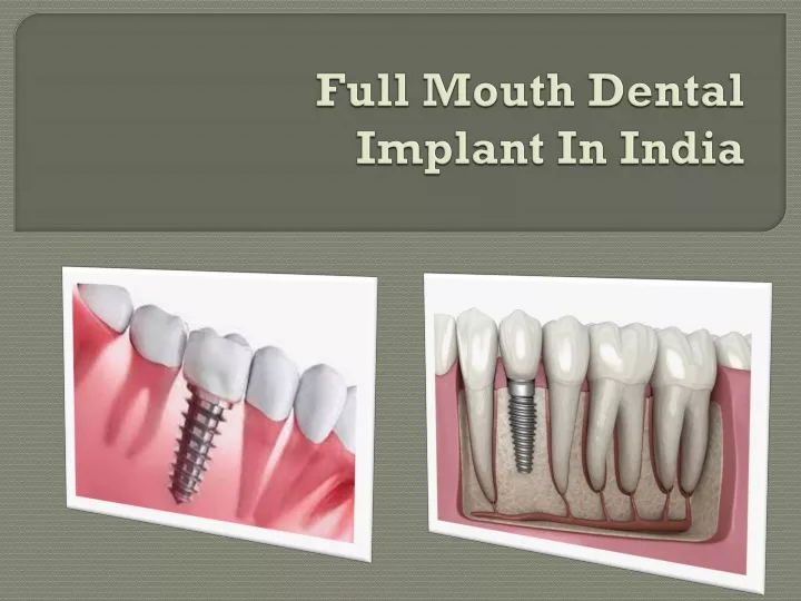 full mouth dental implant in india