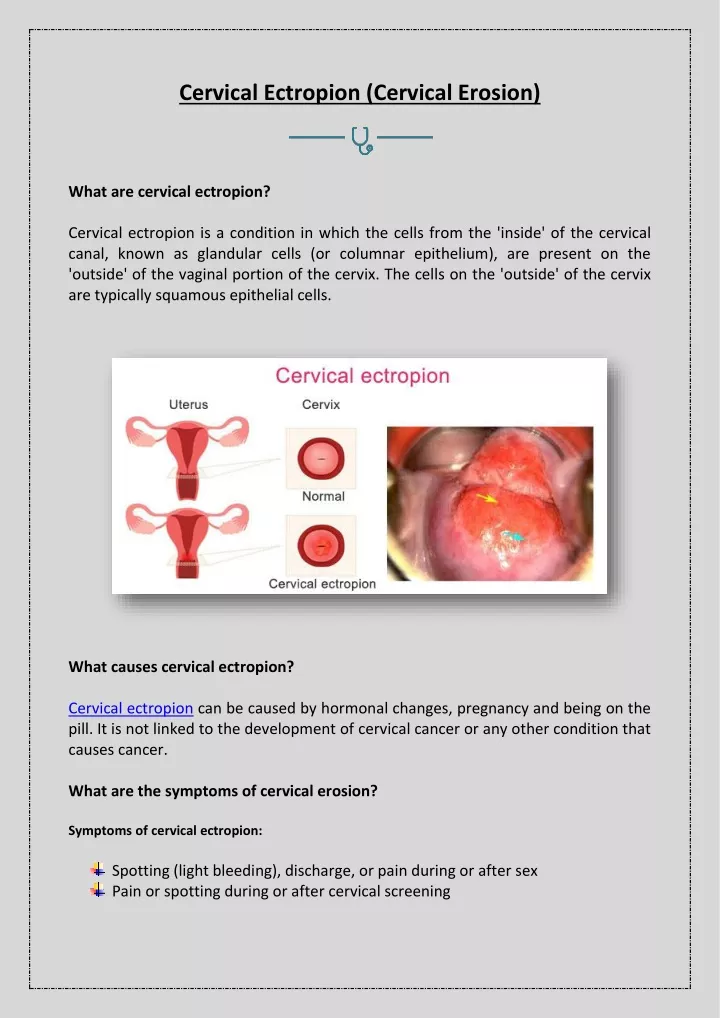 cervical ectropion cervical erosion