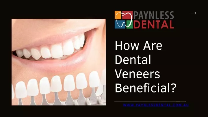 how are dental veneers beneficial