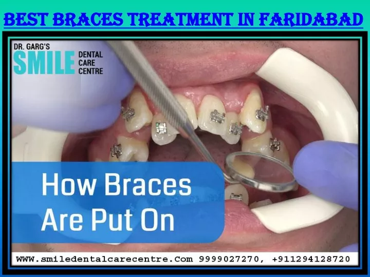 best braces treatment in faridabad