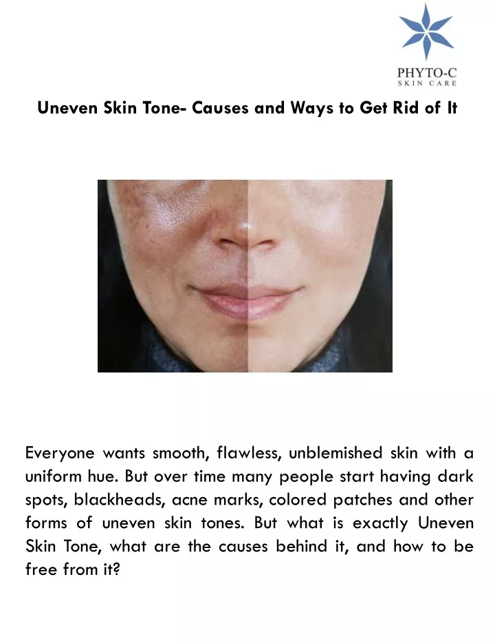 uneven skin tone causes and ways to get rid of it