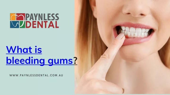 what is bleeding gums