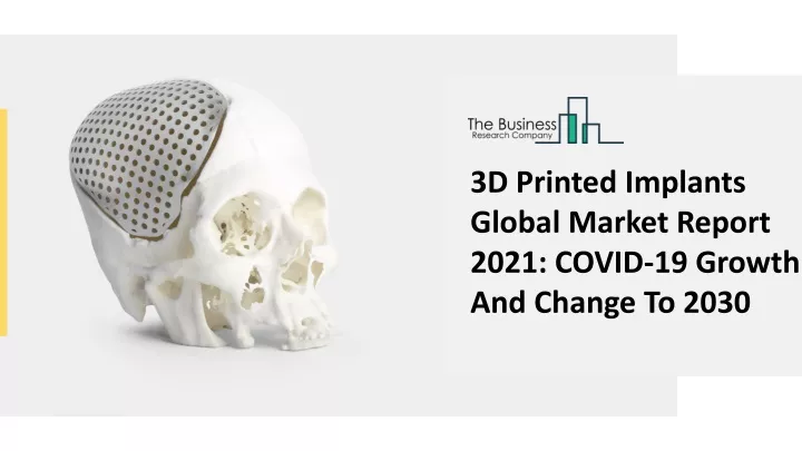 3d printed implants global market report 2021