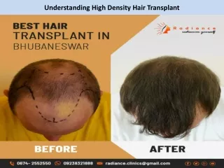 Understanding High Density Hair Transplant