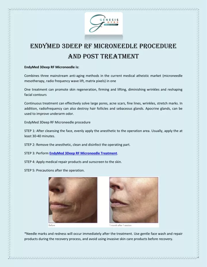 endymed 3deep rf microneedle procedure and post