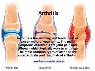 Arthritis Pain Management & Treatment Specialist In Tuggerah