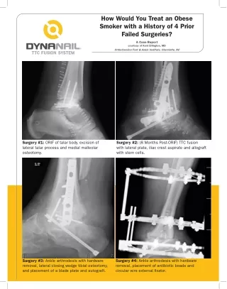 DynaNail® TTC Fusion System - Treatment On an Obese Smoker