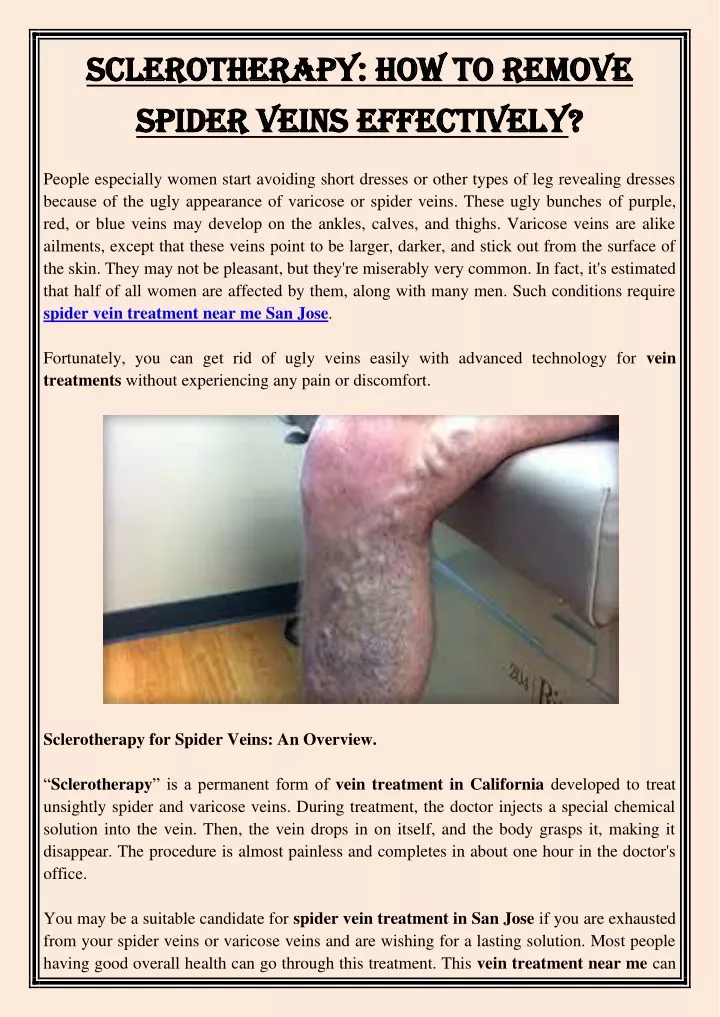 sclerotherapy how to remove sclerotherapy