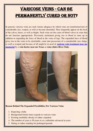 varicose veins varicose veins can be permanently