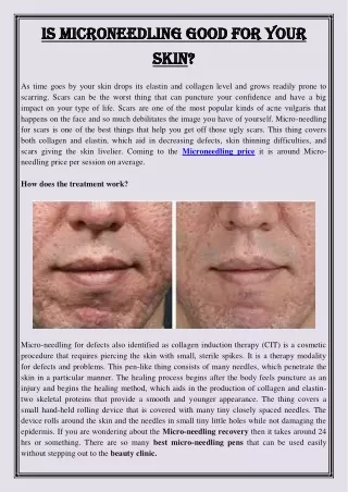 is microneedling good for your is microneedling