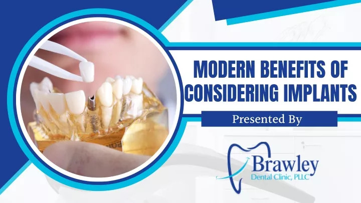 modern benefits of considering implants presented