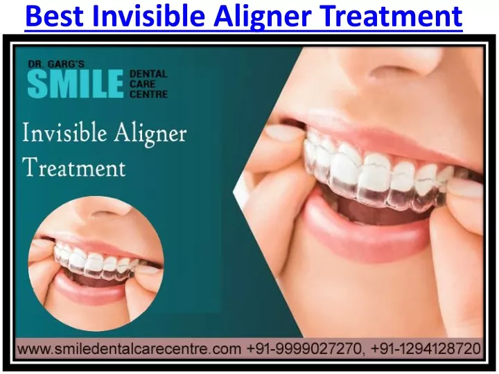 best invisible aligner treatment