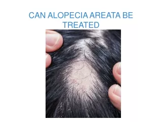 can alopecia areata be treated