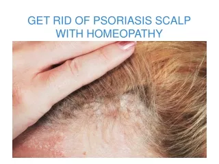 get rid of psoriasis scalp with homeopathy