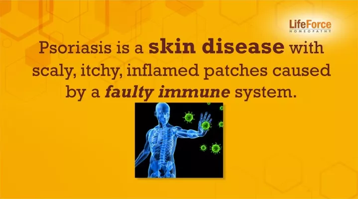 psoriasis is a skin disease with scaly itchy
