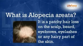 Everything about Alopecia Areata - Treatment, Diagnosis, Cure