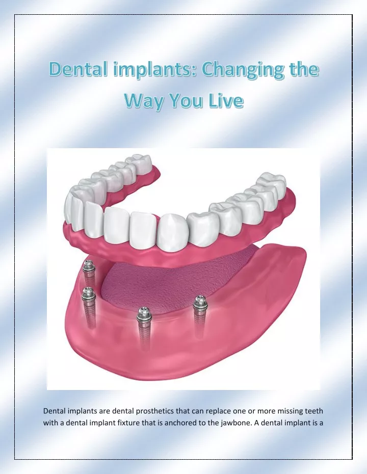 dental implants are dental prosthetics that