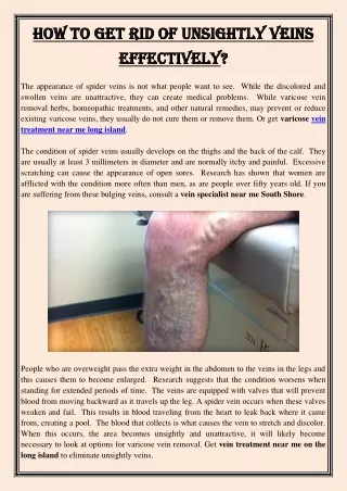 how to get rid of unsightly veins