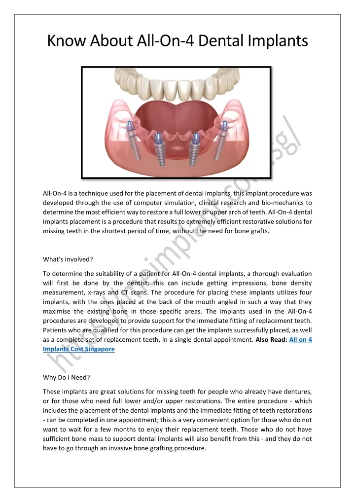 know about all on 4 dental implants
