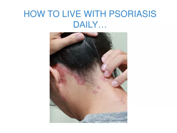 how to live with psoriasis daily