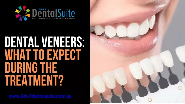 dental veneers what to expect during the treatment