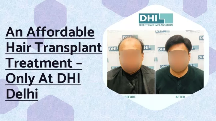 an affordable hair transplant treatment only at dhi delhi