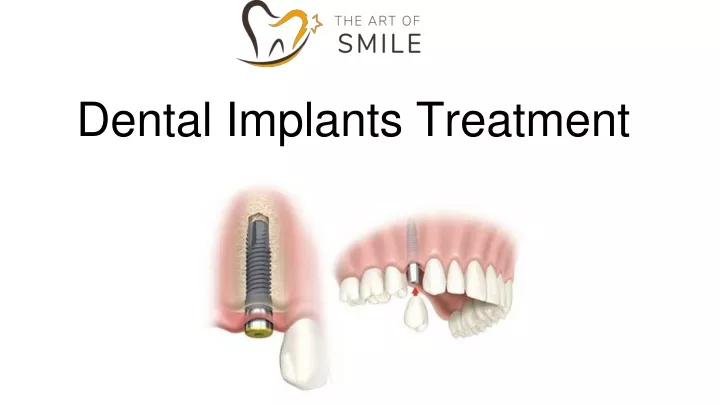 dental implants treatment