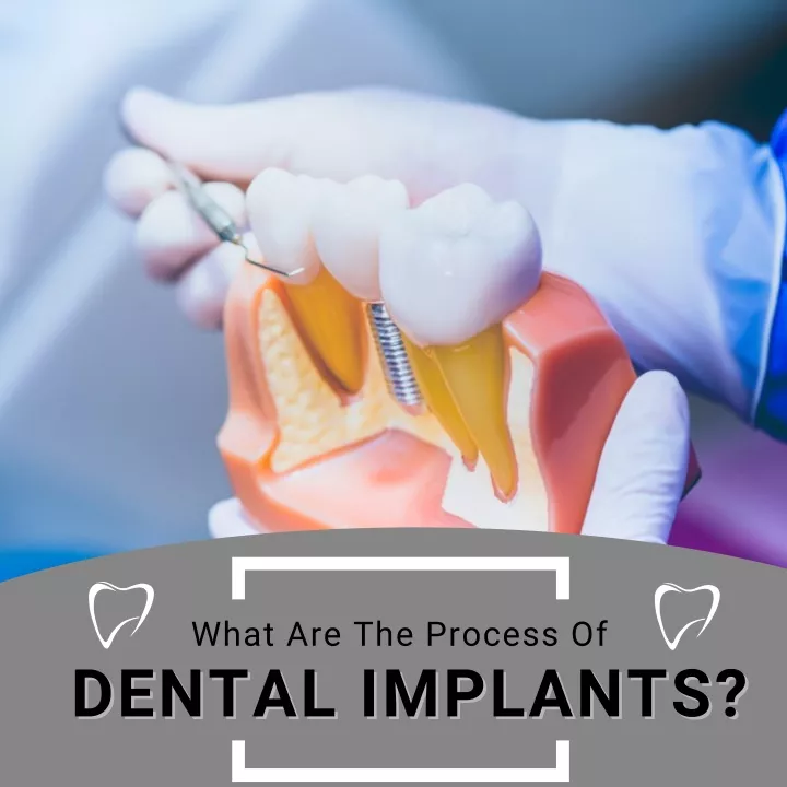 what are the process of dental implants dental