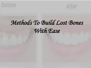 methods to build lost bones with ease