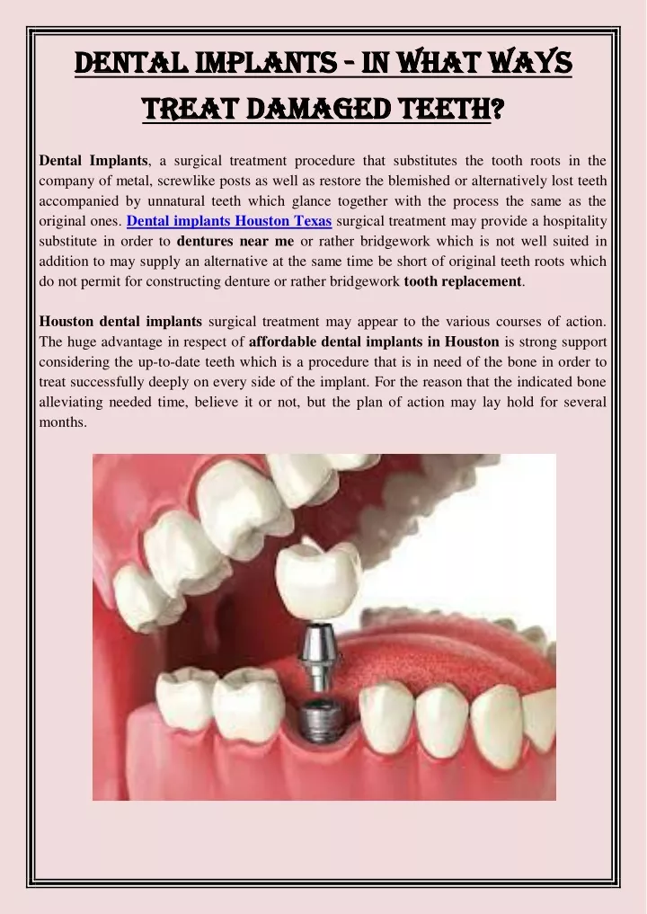 dental implants dental implants in what ways