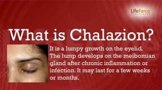 Everything about Chalazion Homeopathic Treatment and Diagnosis