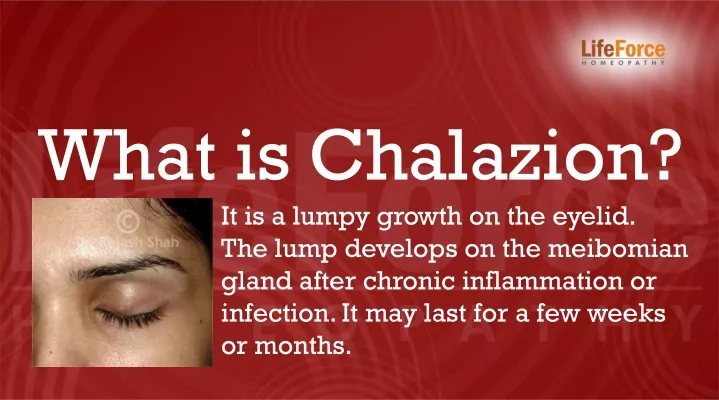 what is chalazion
