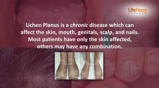 Everything about Lichen Planus - Treatment, Diagnosis, Cure