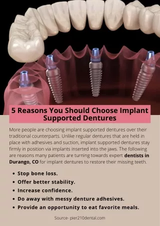 5 Reasons You Should Choose Implant Supported Dentures