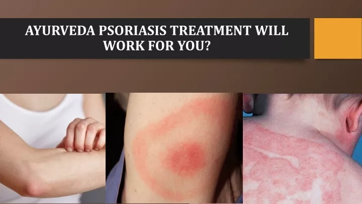 ayurveda psoriasis treatment will work for you