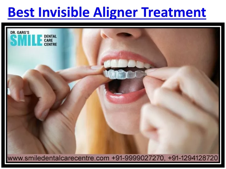 best invisible aligner treatment