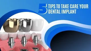 5 Tips To Take Care Your Dental Implants 