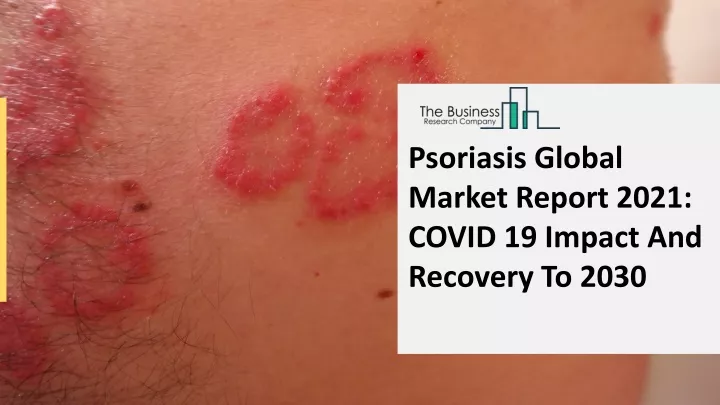 psoriasis global market report 2021 covid