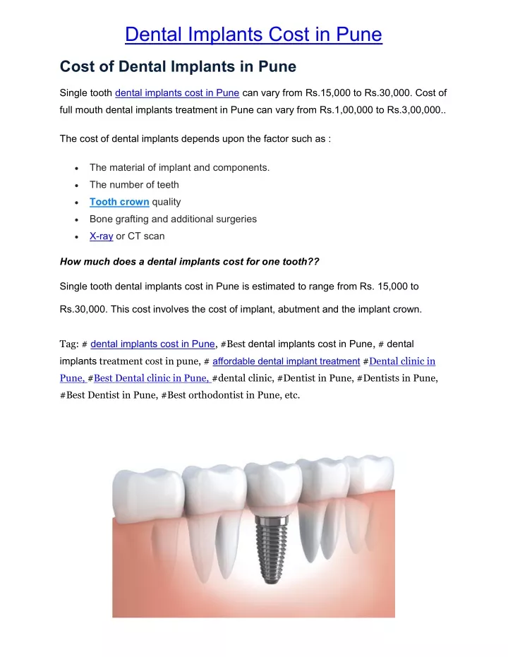 dental implants cost in pune