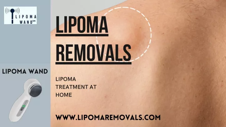 lipoma removals