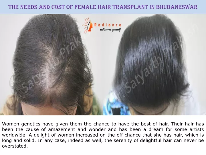 the needs and cost of female hair transplant in bhubaneswar