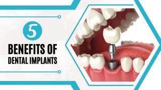 5 Benefits of Dental Implants