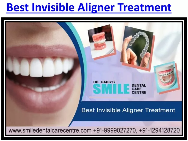 best invisible aligner treatment