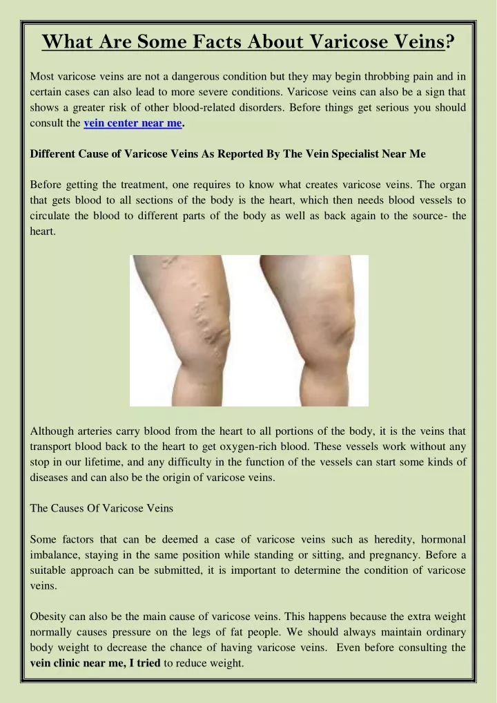 what are some facts about varicose veins