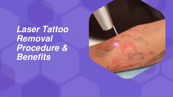 laser tattoo removal procedure benefits