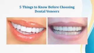 5 Things to Know Before Choosing Dental Veneers