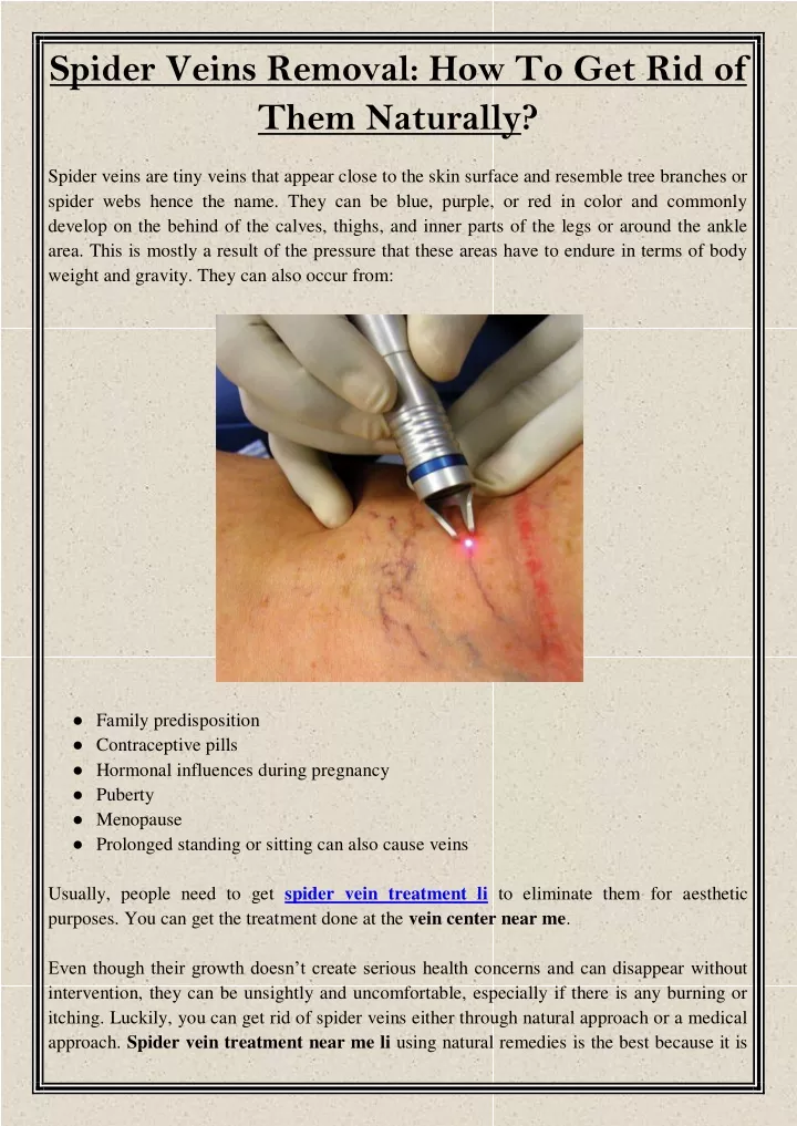 spider veins removal how to get rid of them