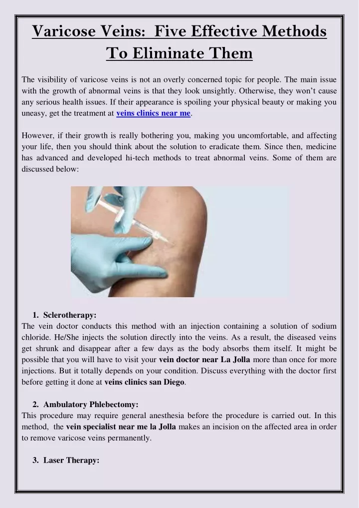 varicose veins five effective methods